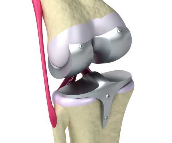 Knee and titanium hinge joint