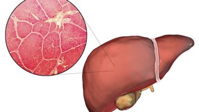 کبدم چربه ، چی بخورم؟