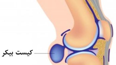 کیست زانو چیست؟
