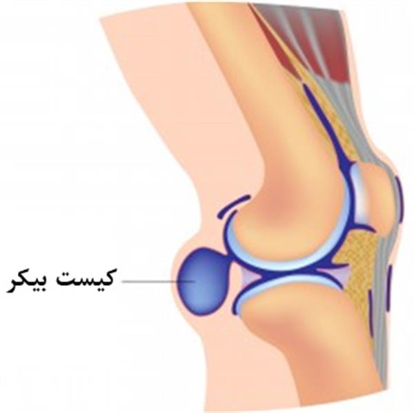 کیست زانو چیست؟