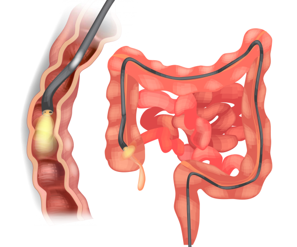 2-Colonoscopy-2048x1365-1.png