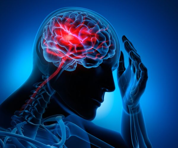 Brain-Attack-Stroke-iStock-1168179084.jpg