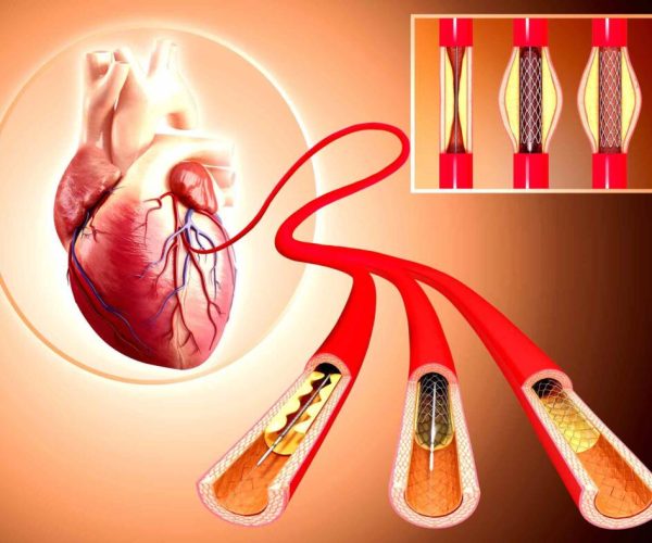 CCoronary-Angioplasty-Treatment-In-SYNERGY-HEART-INSTITUTE-PUNE-1024x788-1.jpg