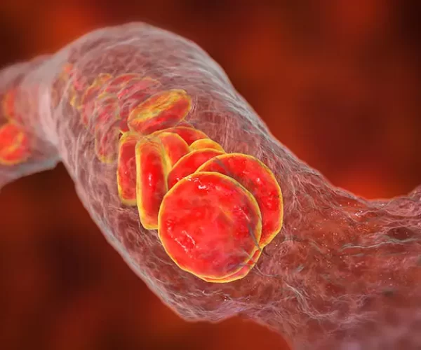 CerebralVasospasm-pezeshket.webp