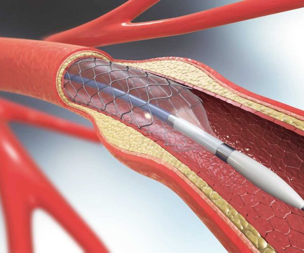 Heart-stent.jpg