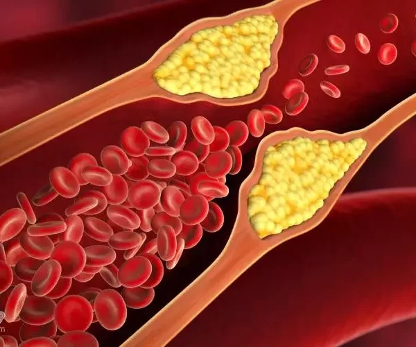 hyperlipidemia-symptoms.webp