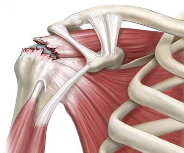 management-of-impingement-and-rotator-cuff-tears-2-768x645-1.jpg
