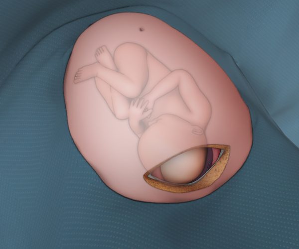 obg001_primaryVertexCsection.jpg
