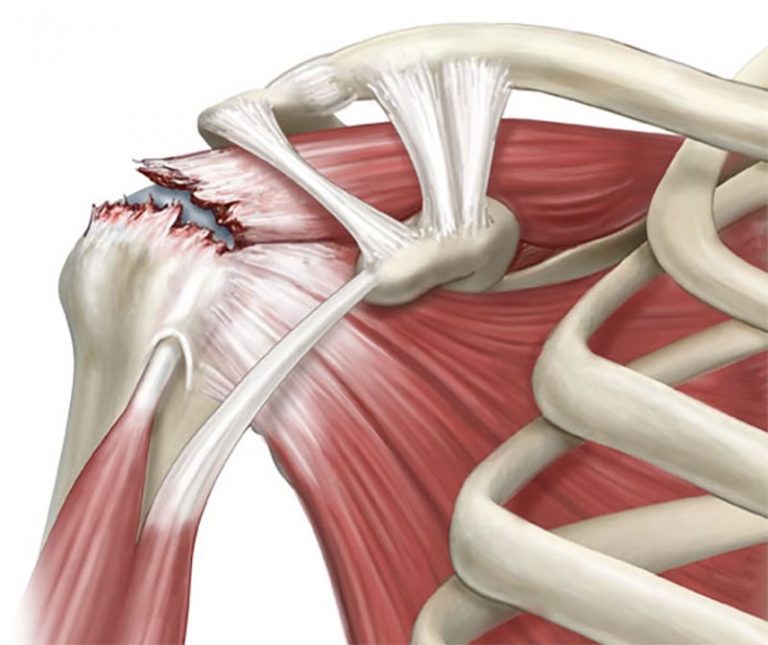 management-of-impingement-and-rotator-cuff-tears-2-768x645