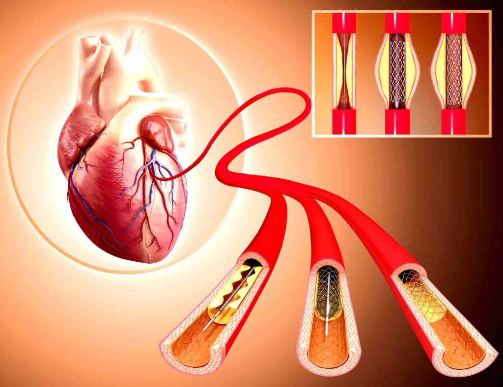 CCoronary-Angioplasty-Treatment-In-SYNERGY-HEART-INSTITUTE-PUNE-1024x788